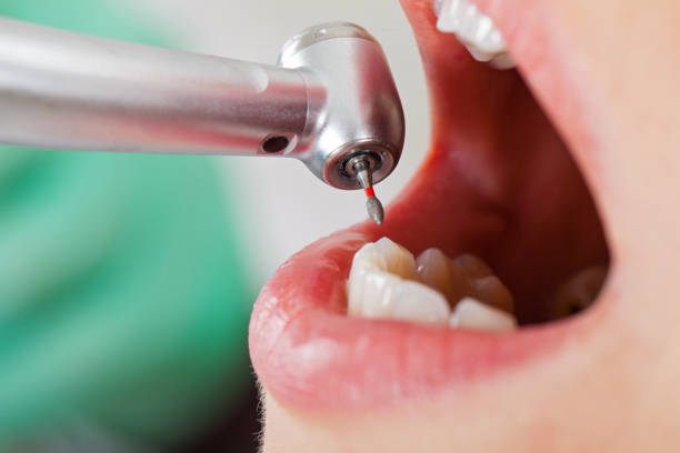 Best Emergency Tooth Extraction in Jamestown, OH